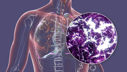 Lungs affected by silicosis, 3D illustration and micrograph