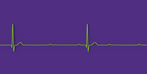 ECG of 3rd degree AV block, 3D illustration