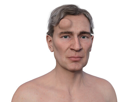 Lipoma on a man's forehead, 3D illustration.