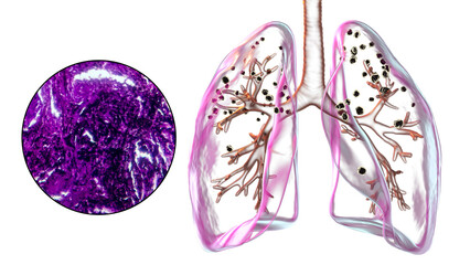 Lungs affected by silicosis, 3D illustration and micrograph