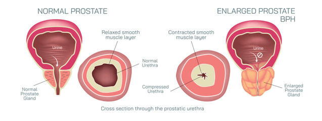 The prostate gland is located just below the bladder in men and surrounds the top portion of the tube that drains urine from the bladder or urethra vector illustration. Students study material. - obrazy, fototapety, plakaty