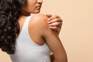 Unhappy young woman scratching her irritated skin on arm