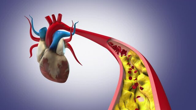 Cholesterol plaque in artery with human heart