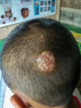 Scalp ringworm with secondary bacteria infection of Asian child
