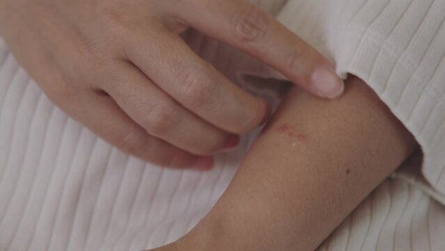 Young Asian woman has itchy and red spots or rash on the skin on her arm from insect bites or allergies. Skin health care