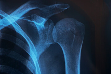 Closeup x-ray of shoulder on gray background - obrazy, fototapety, plakaty