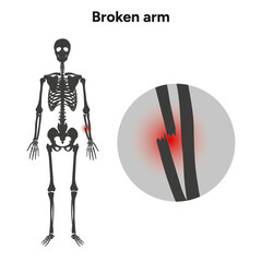 Broken arm, ulna and radius, injuries arm, Significant trauma zoom skeleton