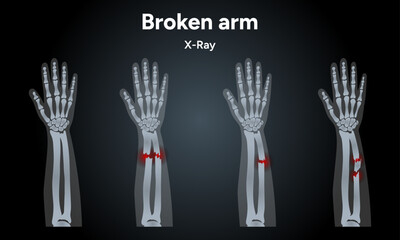 Broken arm, ulna and radius, injuries arm, Significant trauma x-ray