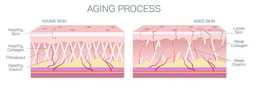 Aging process of skin. Aging skin looks thinner, paler, and clear or translucent. Pigmented spots, including age spots or liver spots may appear in sun exposed areas. Changes in collagen and elastin.