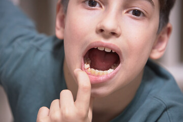 A boy's tooth falls out of his mouth in close-up