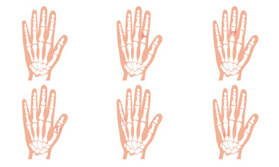 Hand and broken hand bone skeletons. Broken arm, ulna and radius, injuries arm, Significant trauma, falls