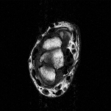 Partial MRI Scan of Broken Left Wrist Series A #13/24