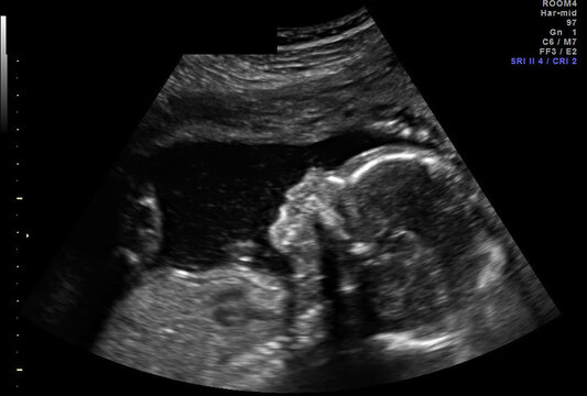 Baby Boy (Male) SONOGRAM Series: Different Angles of Growing in Womb