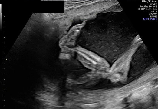 Baby Boy (Male) SONOGRAM Series: Different Angles of Growing in Womb