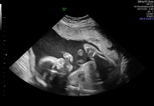 Baby Boy (Male) SONOGRAM Series: Different Angles of Growing in Womb