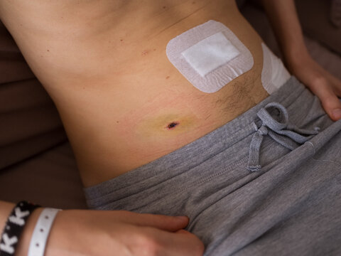 Crop man with sterile patches after surgery