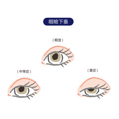 3段階(軽度、中等症、重症)の眼瞼下垂の目
