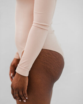 Stretch marks on woman's body skin