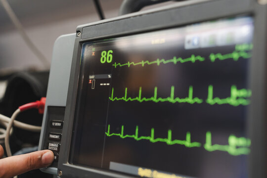 image of the screen of a defibrillator monitor.
