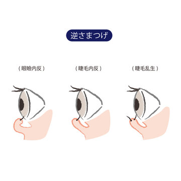 3種類(眼瞼内反、睫毛内反、睫毛乱生)の逆さまつげ