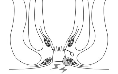 肛門の病気、痔・いぼ痔「血栓性外痔核」　図解イラスト、断面図