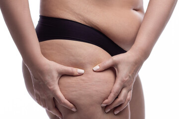 Fragment of a feminine figure with excess weight and cellulite on the legs. A woman squeezes the skin on her thigh with her hands. Obesity and disease. Close-up. Isolated on a white background.