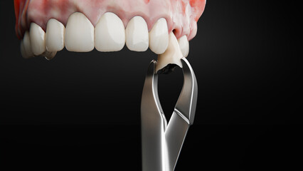 tooth extraction 3d