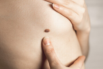 Big birthmark near the woman's breast. Dermatology, health care. Medical treatment.