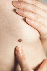 Big birthmark near the woman's breast. Dermatology, health care. Medical treatment.
