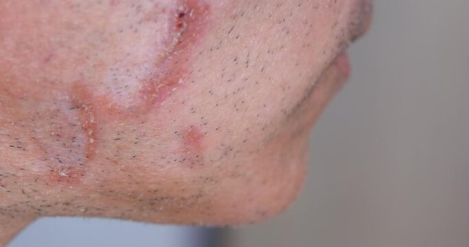 A case of cutaneous sarcoidosis on the face of a man, close up view