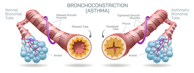 Bronchitis is an inflammation of the bronchial tubes, which are the air passages that carry air to the lungs. It can be either acute or chronic vector illustration - obrazy, fototapety, plakaty