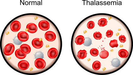 Thalassemia. Close-up of red blood cells