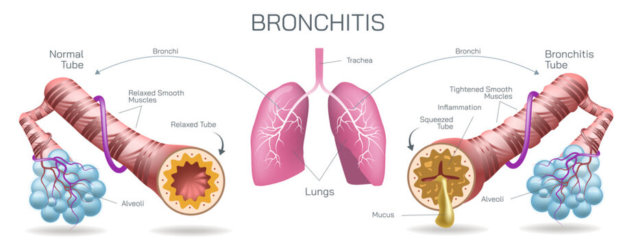Bronchitis is an inflammation of the bronchial tubes, which are the air passages that carry air to the lungs. It can be either acute or chronic vector illustration