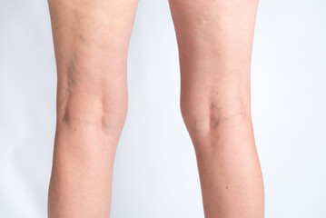 varicose veins and cellulite in women's legs, phlebology, circulation, health