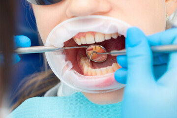 Teeth dentist mouth mirror close-up. Examination of teeth with dental mirror. Ideal teeth. Dental tools. Close up womans teeth with dental mirror. Dent treatment.