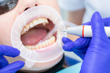 Dental practice, the dentist removes stones and hard plaque from the teeth with the help of ultrasound,patient with retractor and saliva ejector in the mouth