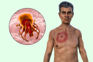 A man with erythema migrans, a characteristic rash of Lyme disease caused by Borrelia burgdorferi, 3D illustration - obrazy, fototapety, plakaty
