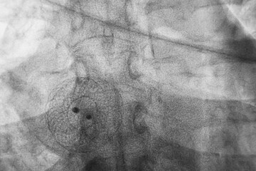 ASD or VSD closure device was deployed under transesophageal echocardiogram during procedure. - obrazy, fototapety, plakaty