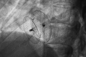 ASD or VSD closure device was deployed under transesophageal echocardiogram during procedure. - obrazy, fototapety, plakaty