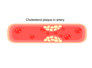 cholesterol plaque in artery for human heart disease	
