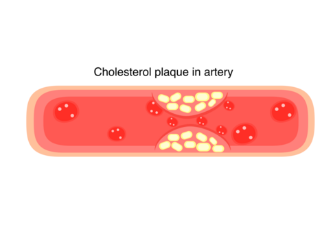 cholesterol plaque in artery for human heart disease	
