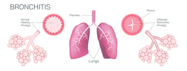 Bronchitis is an inflammation of the bronchial tubes, which are the air passages that carry air to the lungs. It can be either acute or chronic vector illustration - obrazy, fototapety, plakaty
