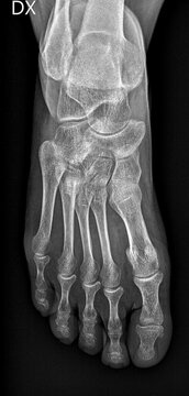 Diagnostic medicine, x-ray image of human foot