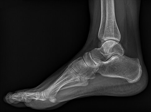 Diagnostic medicine, x-ray image of human foot