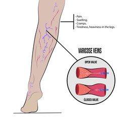 Varicose veins, swollen and twisted veins just under the skin.