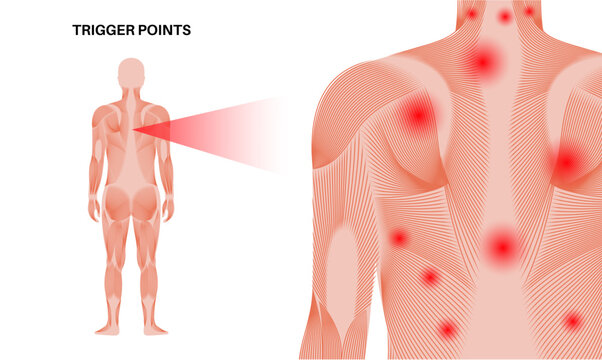 Myofascial trigger points