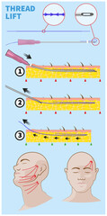 Facelift with ( PDO ) thread lifting technique and equipment illustration