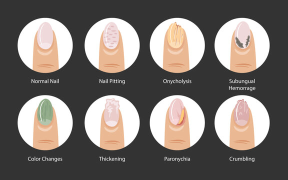 Types of nail pitting disease set collection poster, eight types of nail psoriasis with Healthy, Normal, Pitting, Onycholysis, Subungual, Hematoma, Color Changes, Thickening, Paronychia, Crumbling
