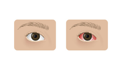 Realistic human healthy eye and with conjunctivitis vector illustration design.
