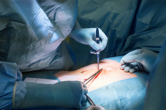 Midsection of doctors with medical equipment operating abdomen at hospital